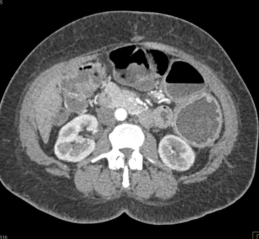 Rectal Cancer with Fluid in Colon - CTisus CT Scan