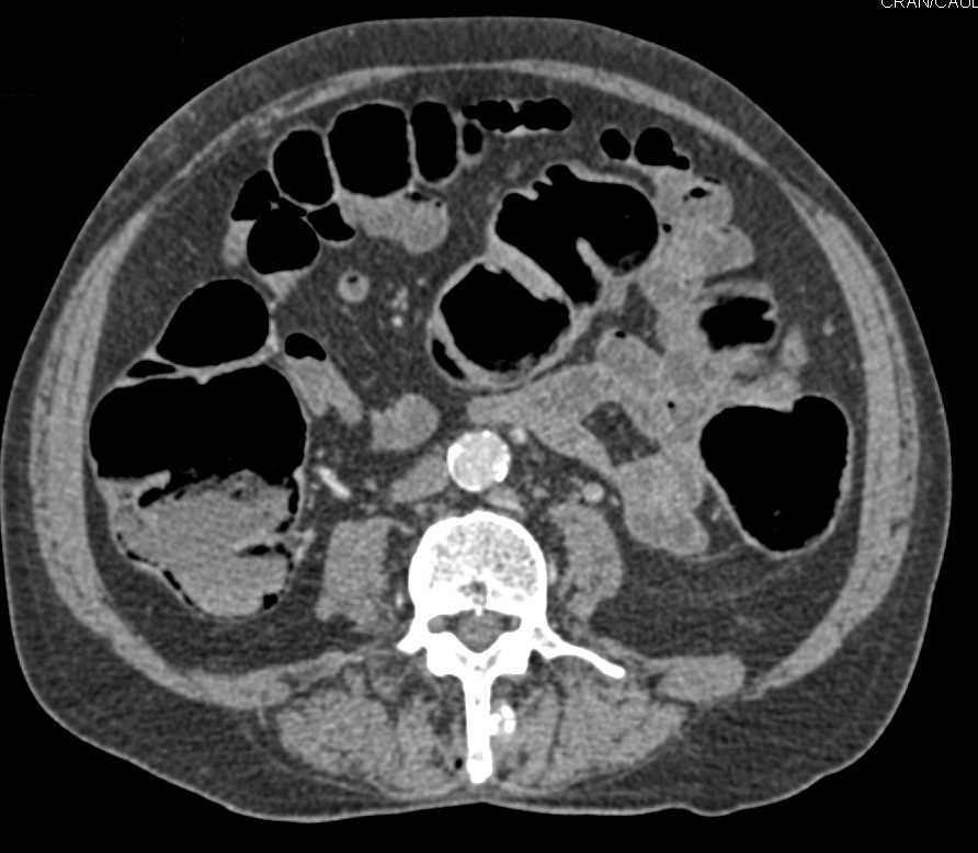 Benign Pneumatosis of the Right Colon - CTisus CT Scan