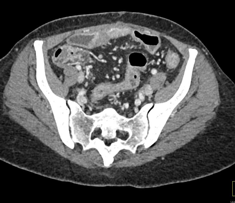 Crohn's Colitis Involves Small Bowel and Colon - CTisus CT Scan