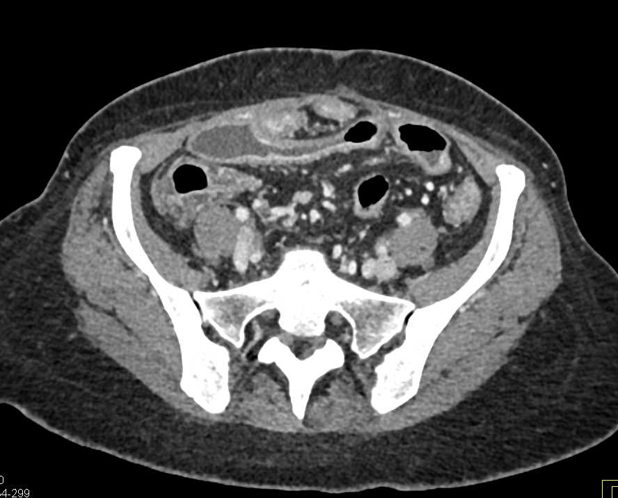 Crohn's Colitis Involves Small Bowel and Colon - CTisus CT Scan