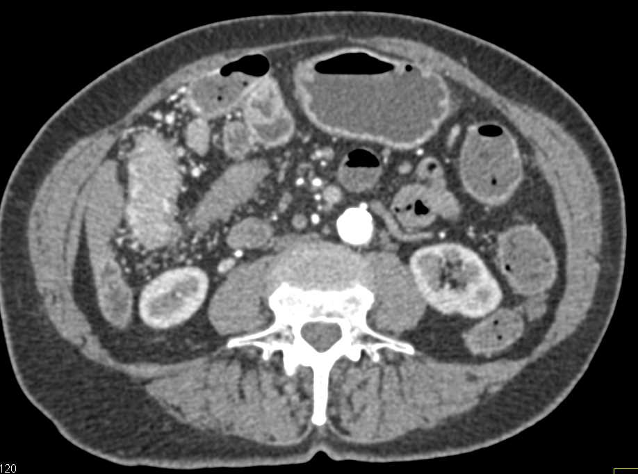 Amazing Enhancement of Colon Looks Like Ischemia but Was Normal at  Surgery - CTisus CT Scan