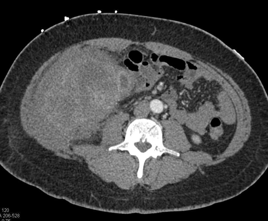 Right Colon Cancer with Carcinomatosis - CTisus CT Scan