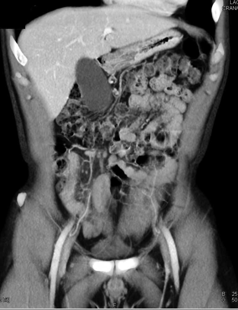 Acute Appendicitis - CTisus CT Scan