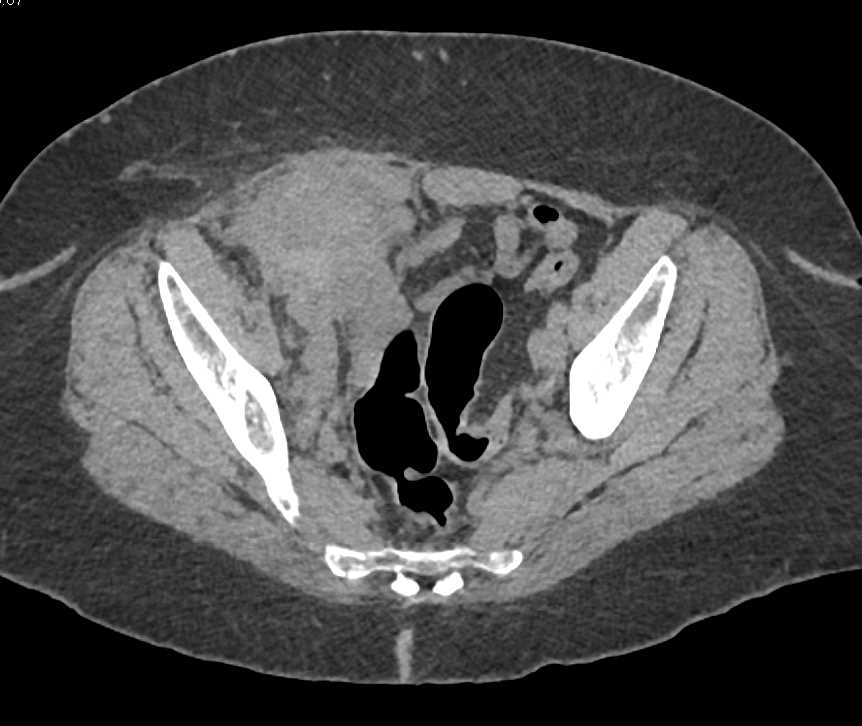 Recurrent Colon Cancer Involves the Abdominal Wall - CTisus CT Scan