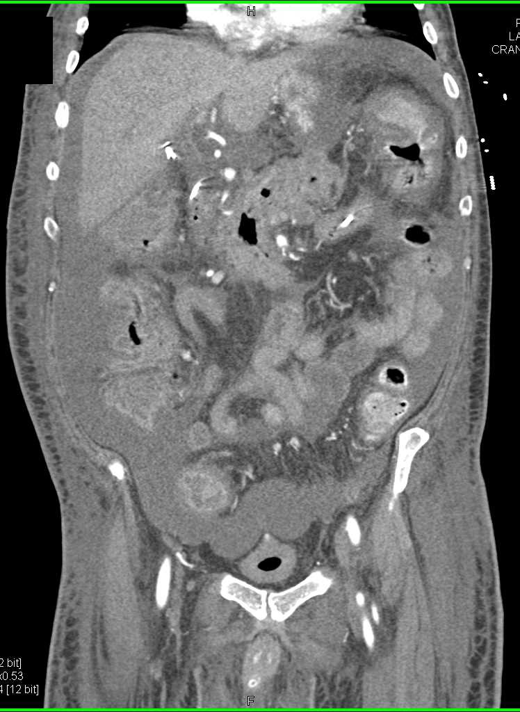 Carcinoma with Thickened Right Colon - CTisus CT Scan