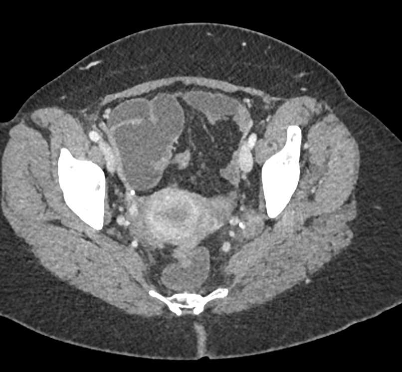 Appendiceal Perforation and Abscess - CTisus CT Scan