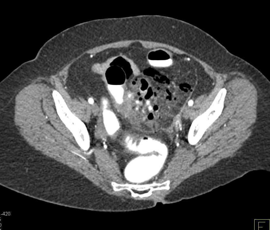 Diverticulitis with Abscess and Inflammation - CTisus CT Scan