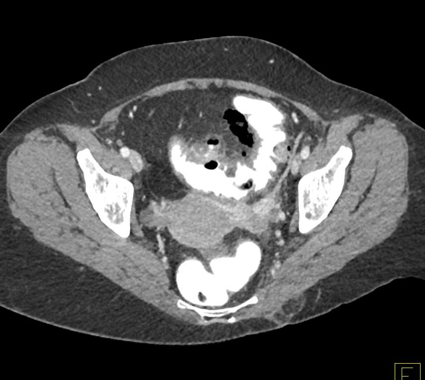 Diverticulitis with Abscess and Inflammation in Sigmoid Colon - CTisus CT Scan