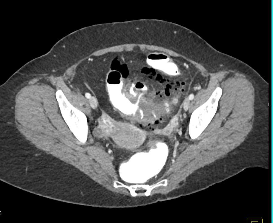 Diverticulitis with Abscess and Inflammation in Sigmoid Colon - CTisus CT Scan