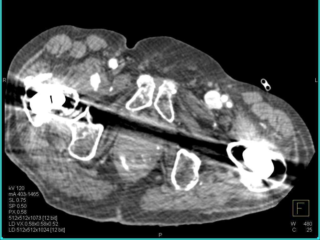 Colitis Sigmoid Colon and Inflammation - CTisus CT Scan
