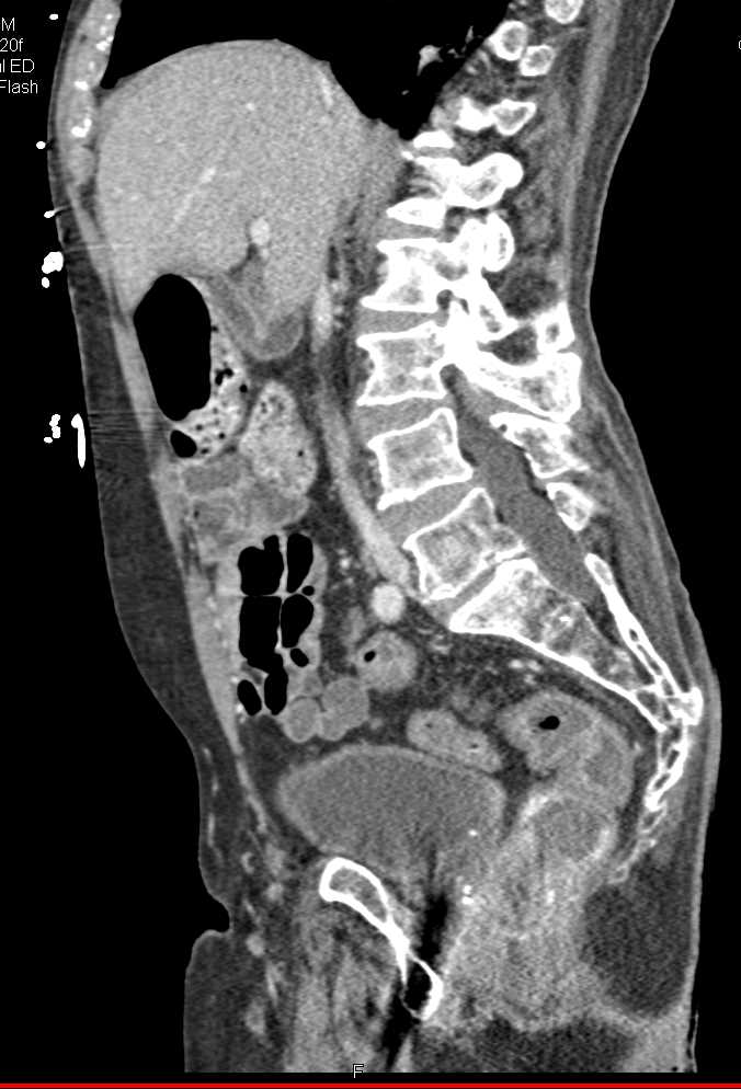 Colitis Sigmoid Colon and Rectum and Suspected Active Bleed - CTisus CT Scan