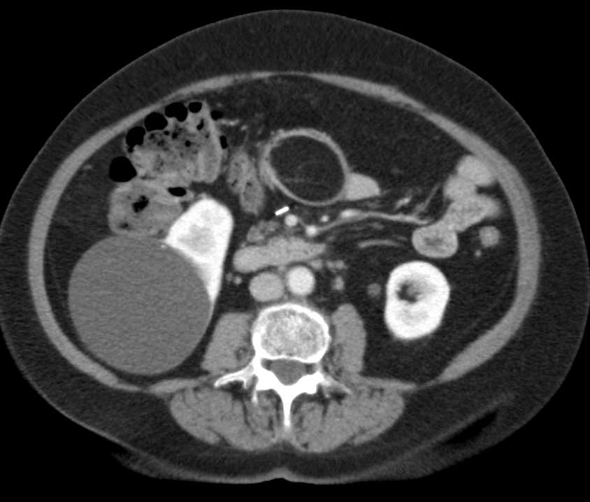 Lipoma in the Transverse Colon - CTisus CT Scan