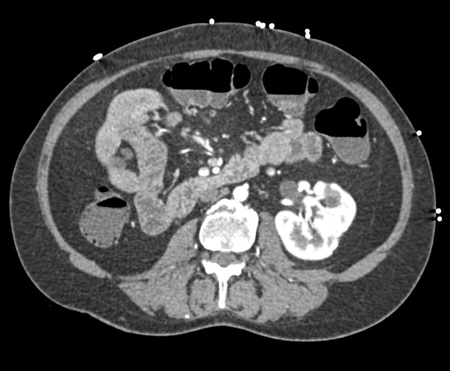Ulcerative Colitis with Inflammation and Increased Vascularity in the Rectum - CTisus CT Scan