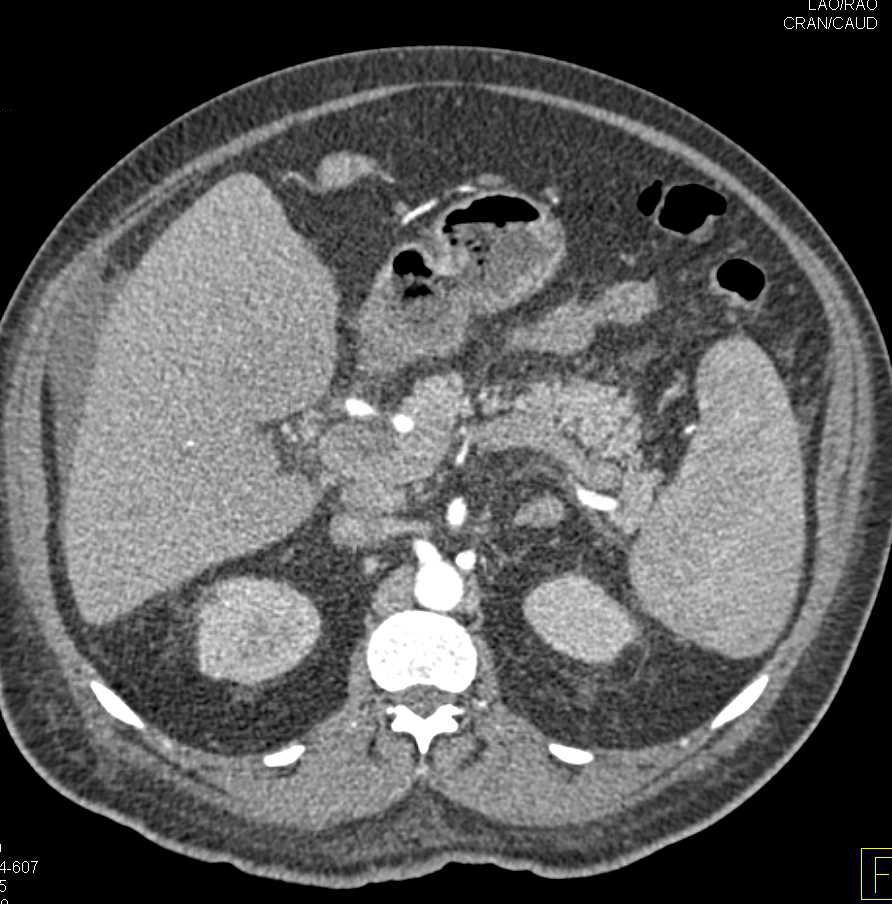 Pneumatosis Right Colon with Thrombus in Portal Vein and Superior Mesenteric Vein (SMV) - CTisus CT Scan