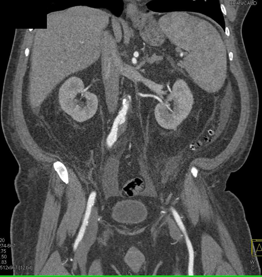 Pneumatosis Right Colon with Thrombus in Portal Vein and Superior ...