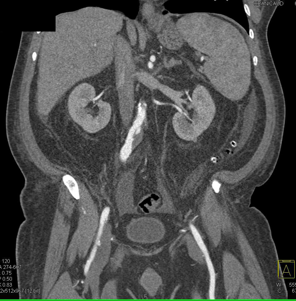 Pneumatosis Right Colon with Thrombus in Portal Vein and Superior ...