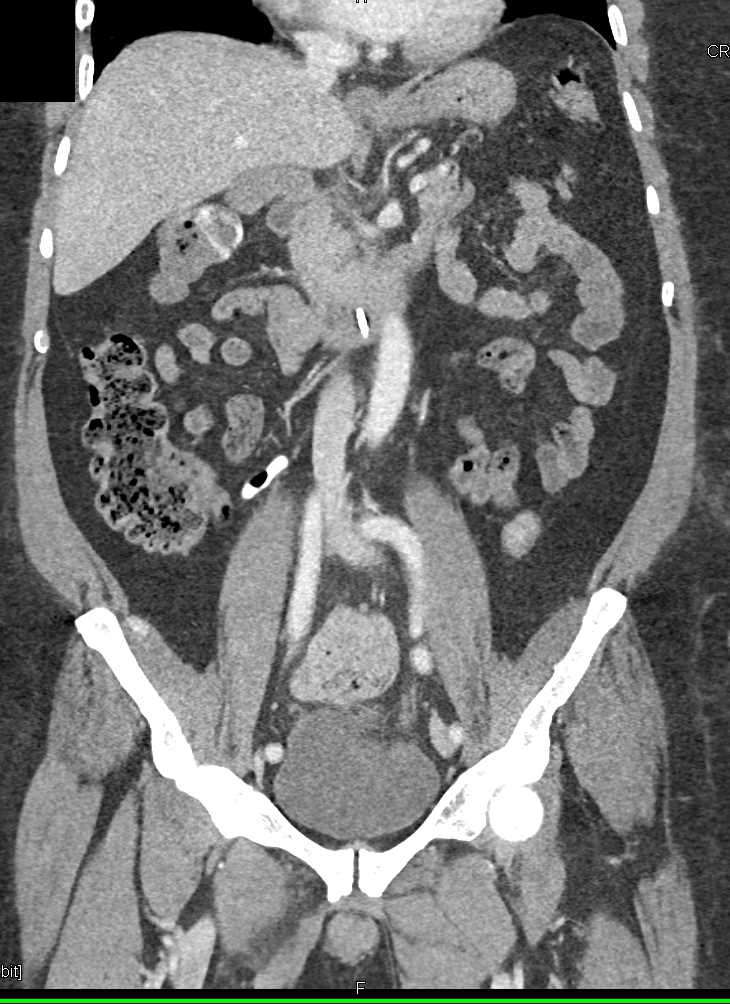GI Bleed in Hepatic Flexure - CTisus CT Scan