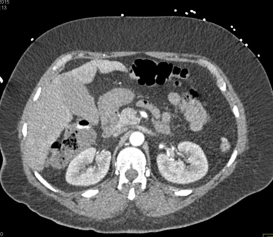 GI Bleed in Hepatic Flexure - CTisus CT Scan