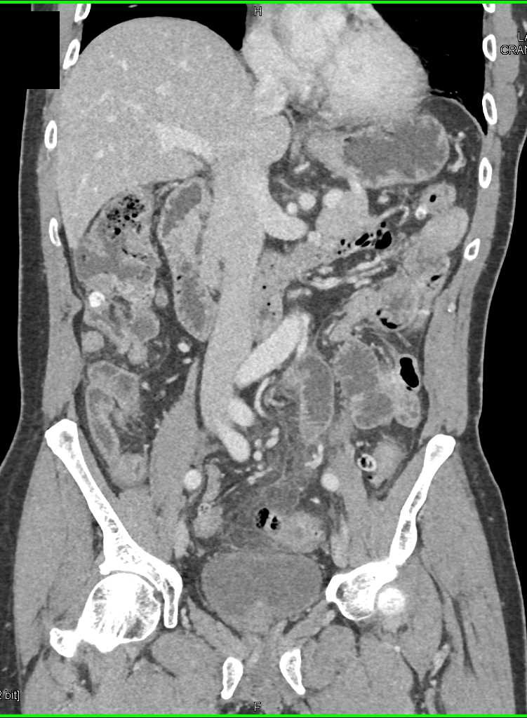 Focal Sigmoid Diverticulitis with Perforation - CTisus CT Scan