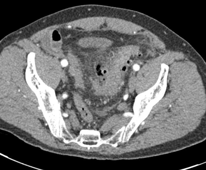 Focal Sigmoid Diverticulitis with Perforation - CTisus CT Scan