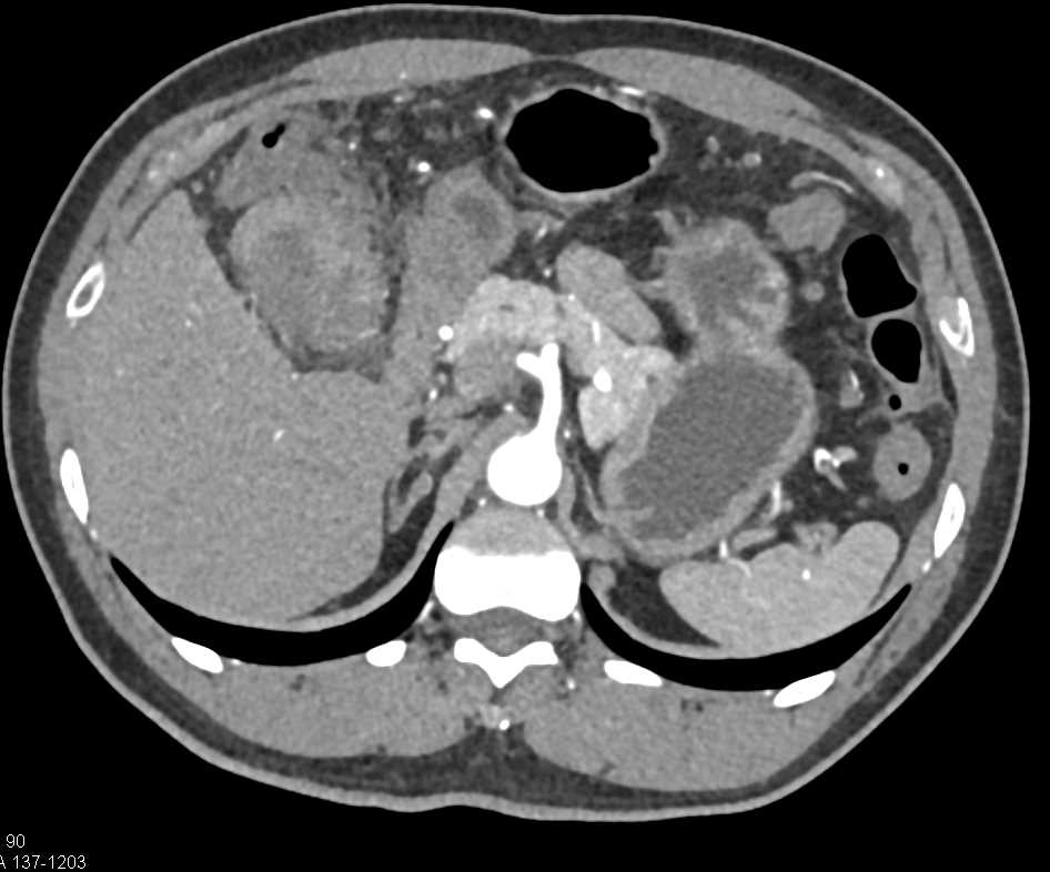 Carcinoma of Hepatic Flexure with Local Nodes and Spread of Disease - CTisus CT Scan