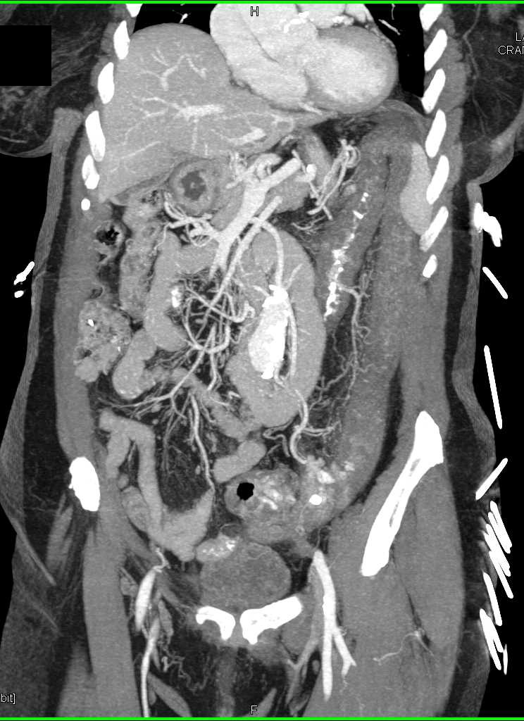 Ulcerative Colitis Left Colon - CTisus CT Scan