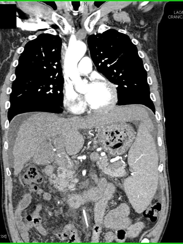 Thickened Right Colon in Patient with Cirrhosis and Portal Hypertension - CTisus CT Scan