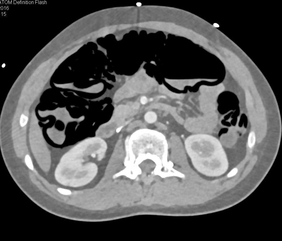 Extensive Pneumatosis Colon - CTisus CT Scan