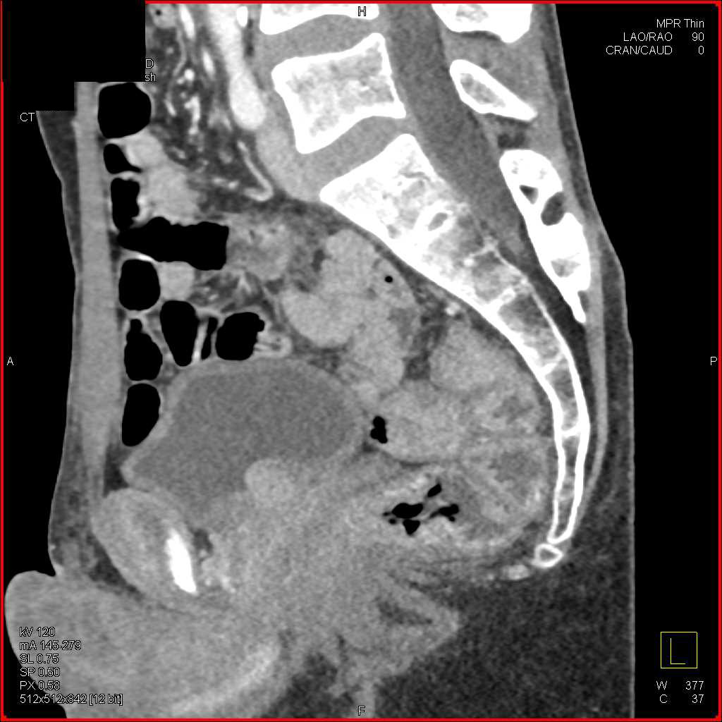 Rectal Cancer Colon Case Studies CTisus CT Scanning