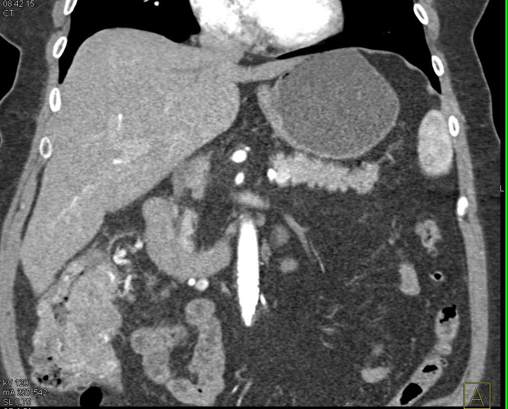 Cecal Carcinoma - CTisus CT Scan