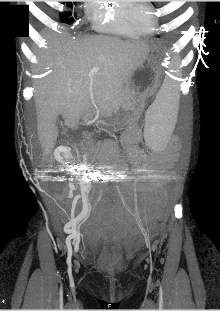 Bleed in Ostomy With Large Varices  Present - CTisus CT Scan