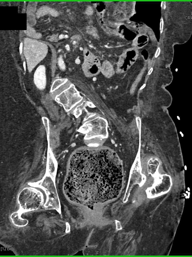 Stercoral Colitis - CTisus CT Scan