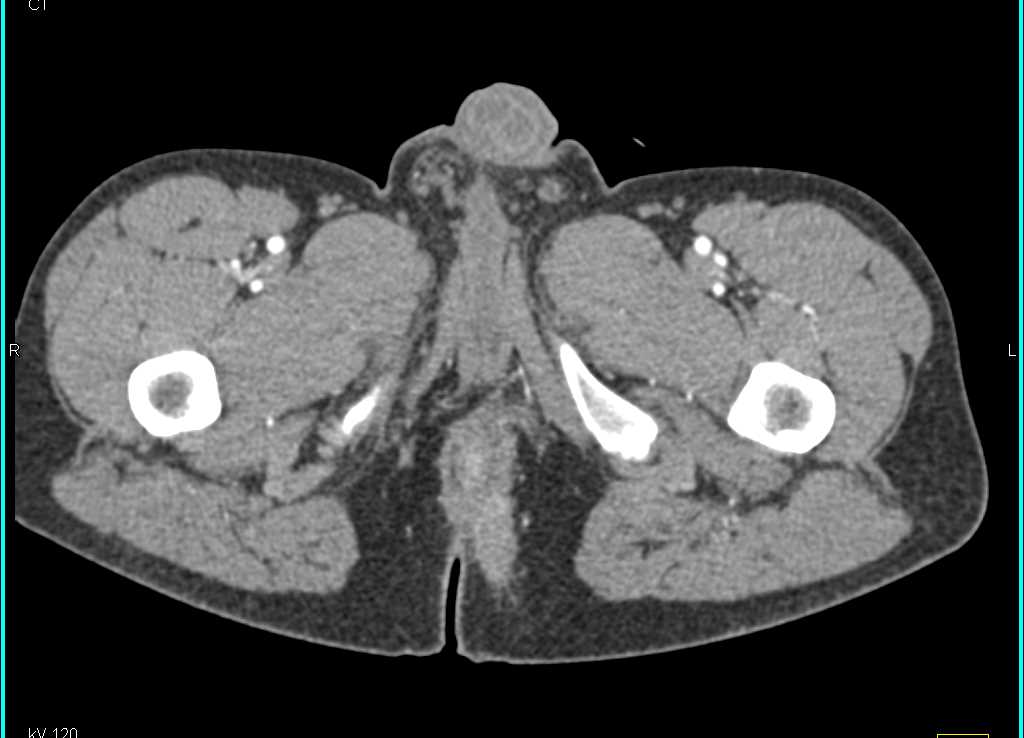 Enhancement with Inflammation of Rectal Pouch - CTisus CT Scan