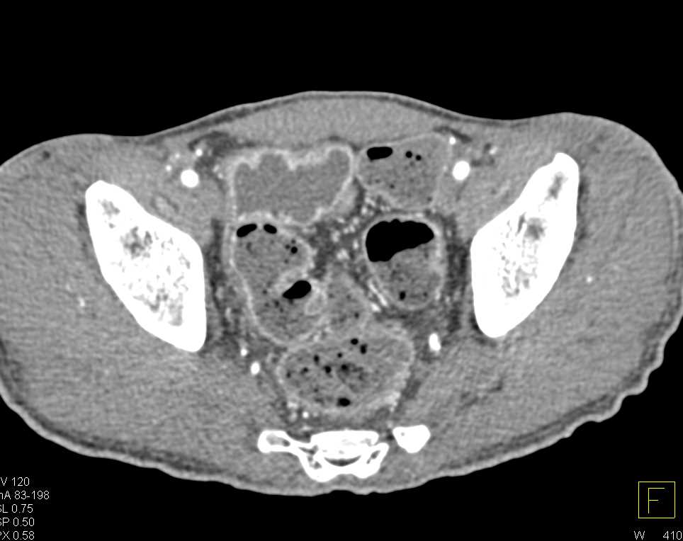 Inflammatory Bowel Disease - CTisus CT Scan