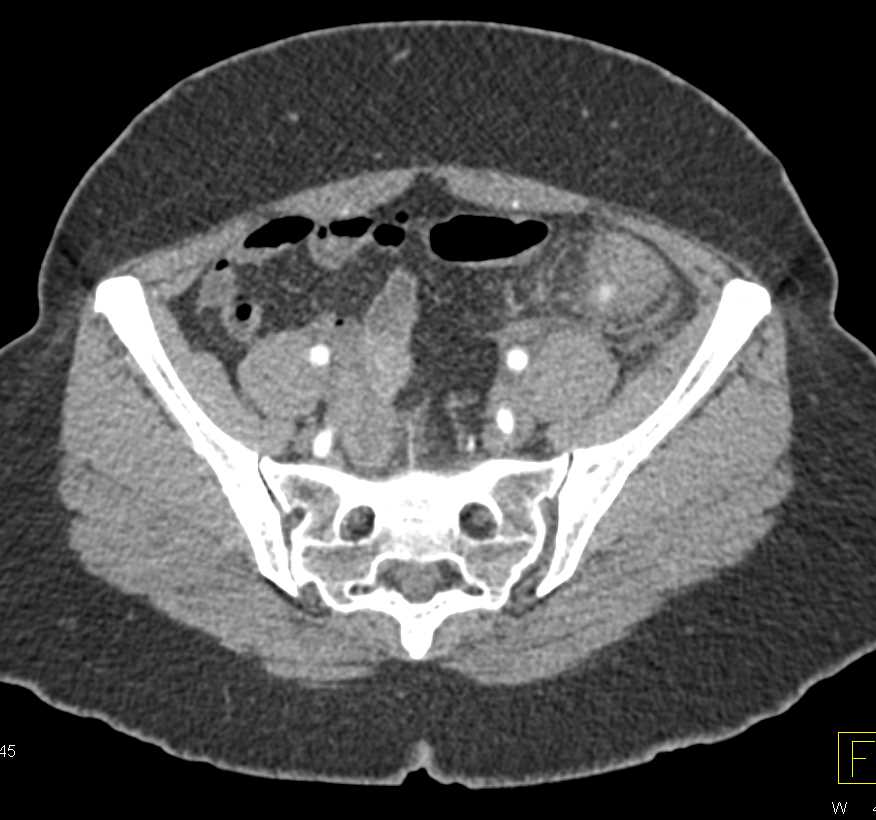 Diverticulitis Involves the Descending Colon - CTisus CT Scan