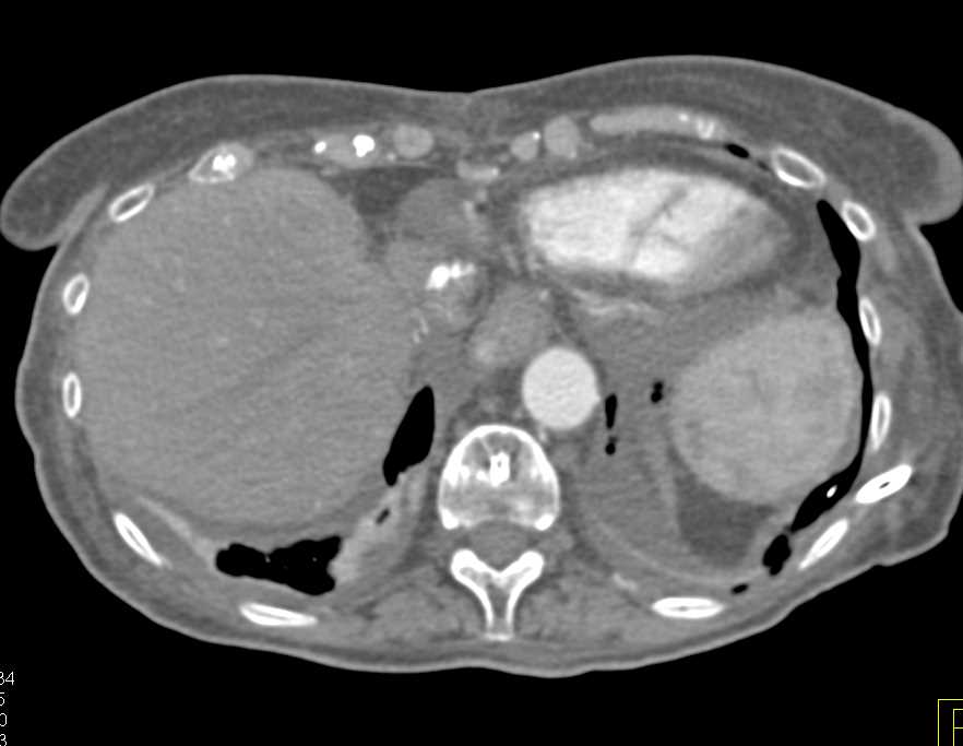 Ischemic Bowel with Pneumatosis Right Colon - CTisus CT Scan