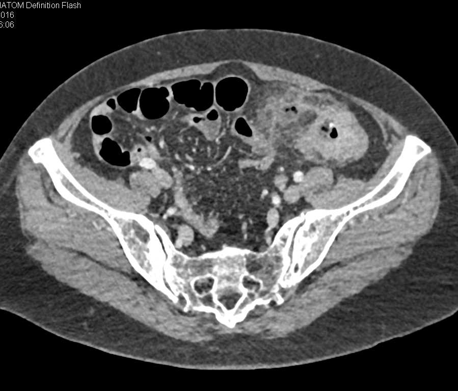 Apple Core Lesion Near Sigmoid Colon with Focal Perforation - CTisus CT Scan