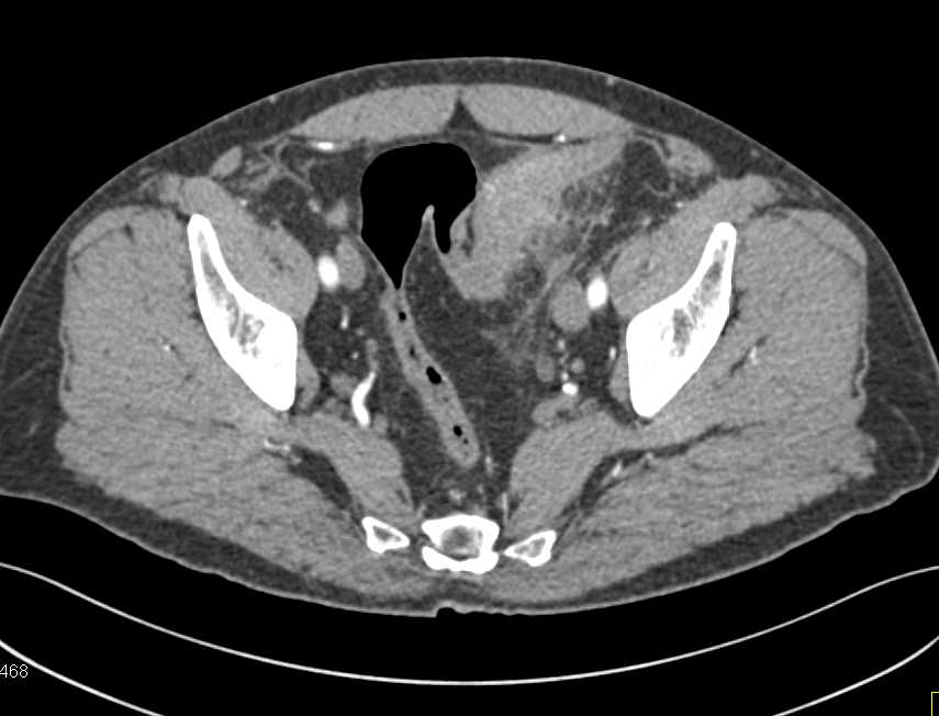 Diverticulitis Sigmoid Colon - CTisus CT Scan