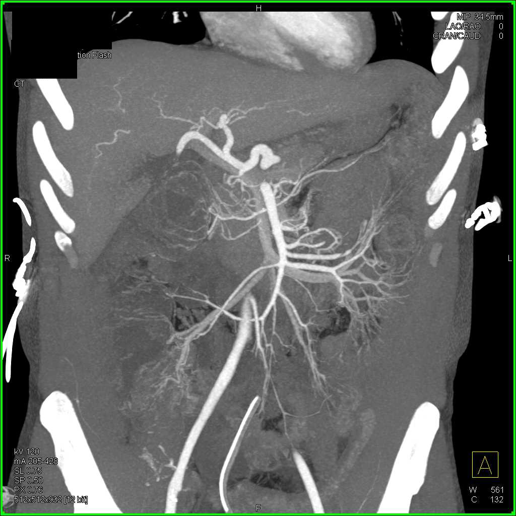 Colitis Descending Colon - CTisus CT Scan