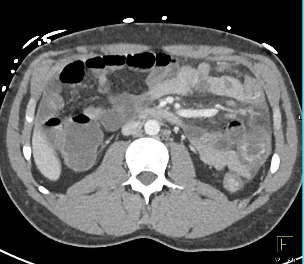 Ischemic Colitis Descending Colon - CTisus CT Scan