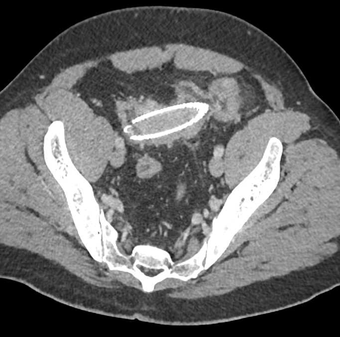 Colon Cancer with Stent in Sigmoid Colon - CTisus CT Scan