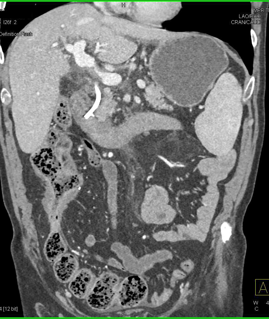 Crohn's Disease with Stricture in Ascending Colon - CTisus CT Scan