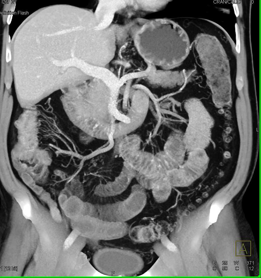 Crohn's Disease - CTisus CT Scan