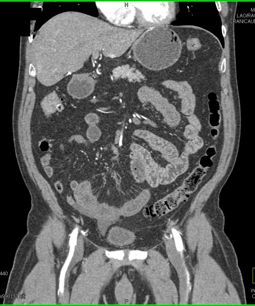 Crohn's Disease Right Colon - CTisus CT Scan