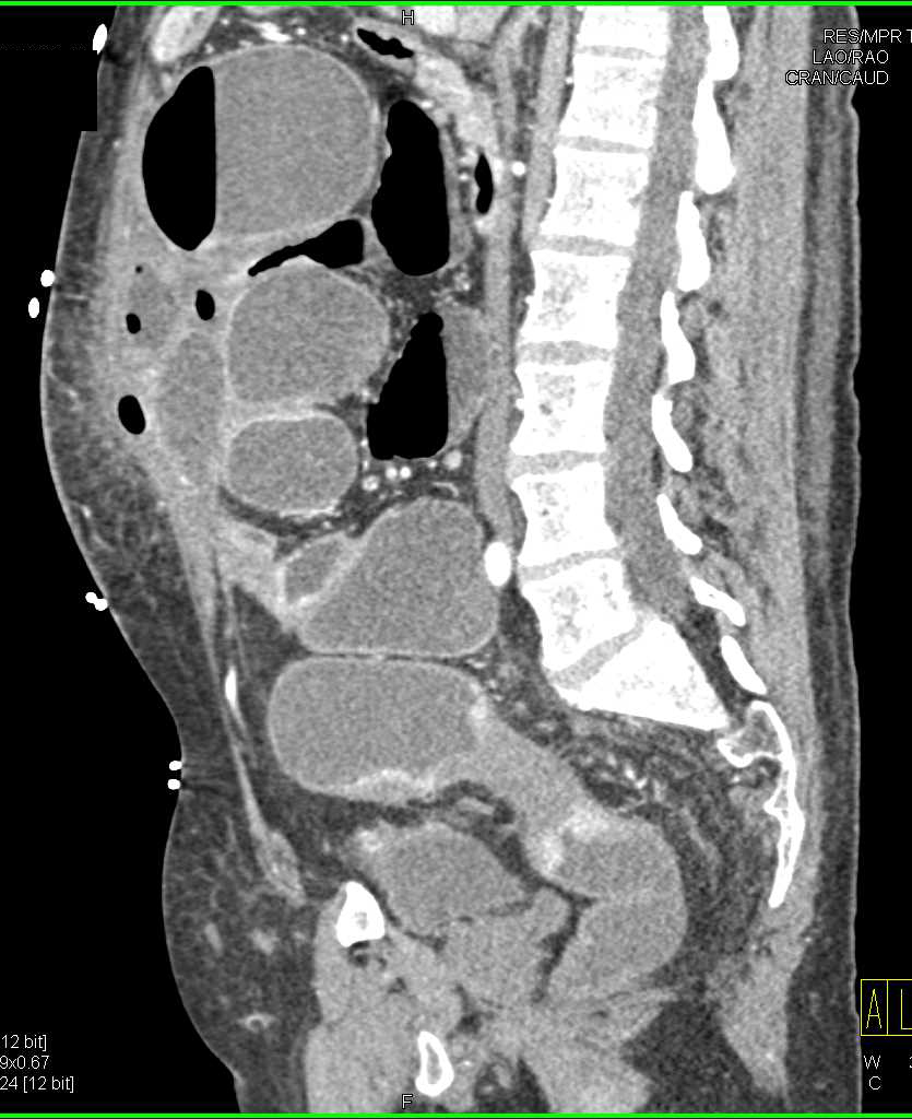 Multiple Ischemic Strictures in the Colon Best Seen in the Rectum - CTisus CT Scan