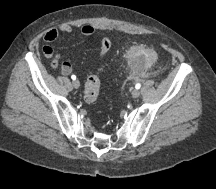 Diverticulitis with Focal Abscess - CTisus CT Scan