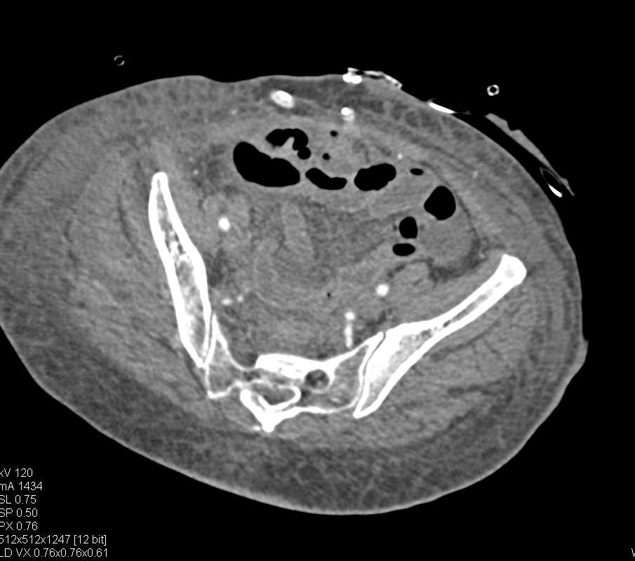 Active Rectal Bleed - CTisus CT Scan