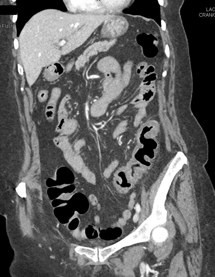 Pseudomembranous Colitis Descending Colon - CTisus CT Scan