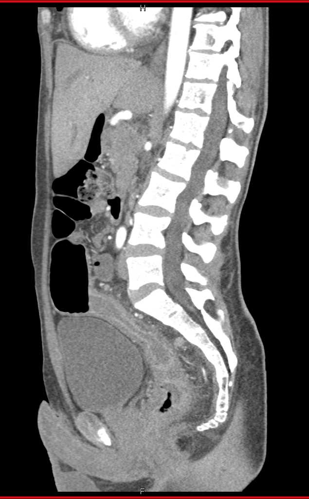 Ulcerative Colitis Rectum - CTisus CT Scan