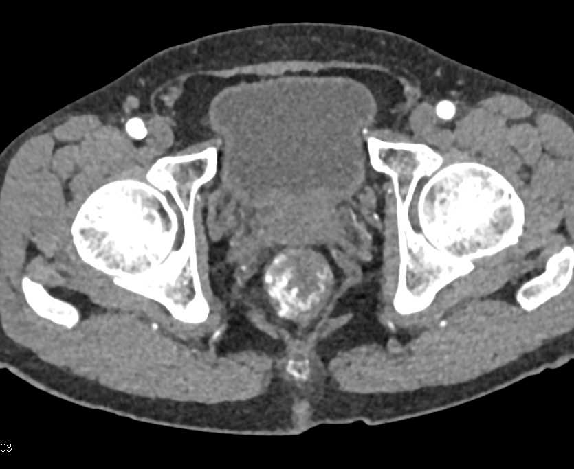 Rectal Varices and Gastrointestinal (GI) Bleed - CTisus CT Scan